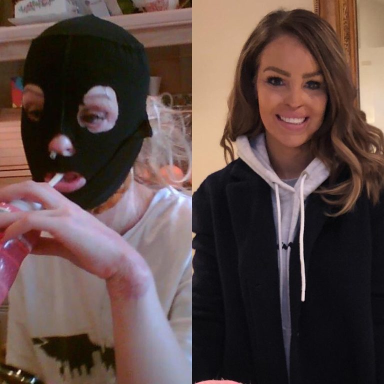 Katie Piper shared inspirational 10 year challenge post with fans on ...