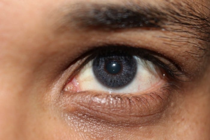 Get all the right data on Laser Eye Color Change Surgery - Conclud